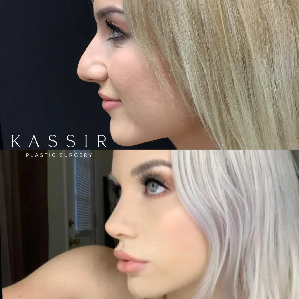 Real patient case Rhinoplasty, NYC and New Jersey, Dr. Kassir