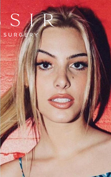 Real patient case after Rhinoplasty, NYC and New Jersey, Dr. Kassir