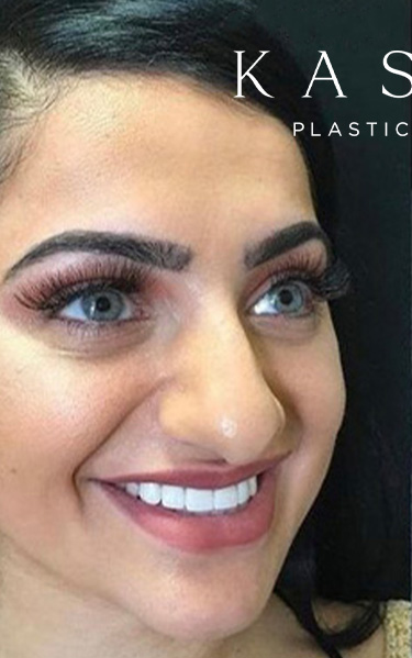 Real patient case before Rhinoplasty, NYC and New Jersey, Dr. Kassir