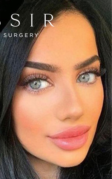 Real patient case after Rhinoplasty, NYC and New Jersey, Dr. Kassir