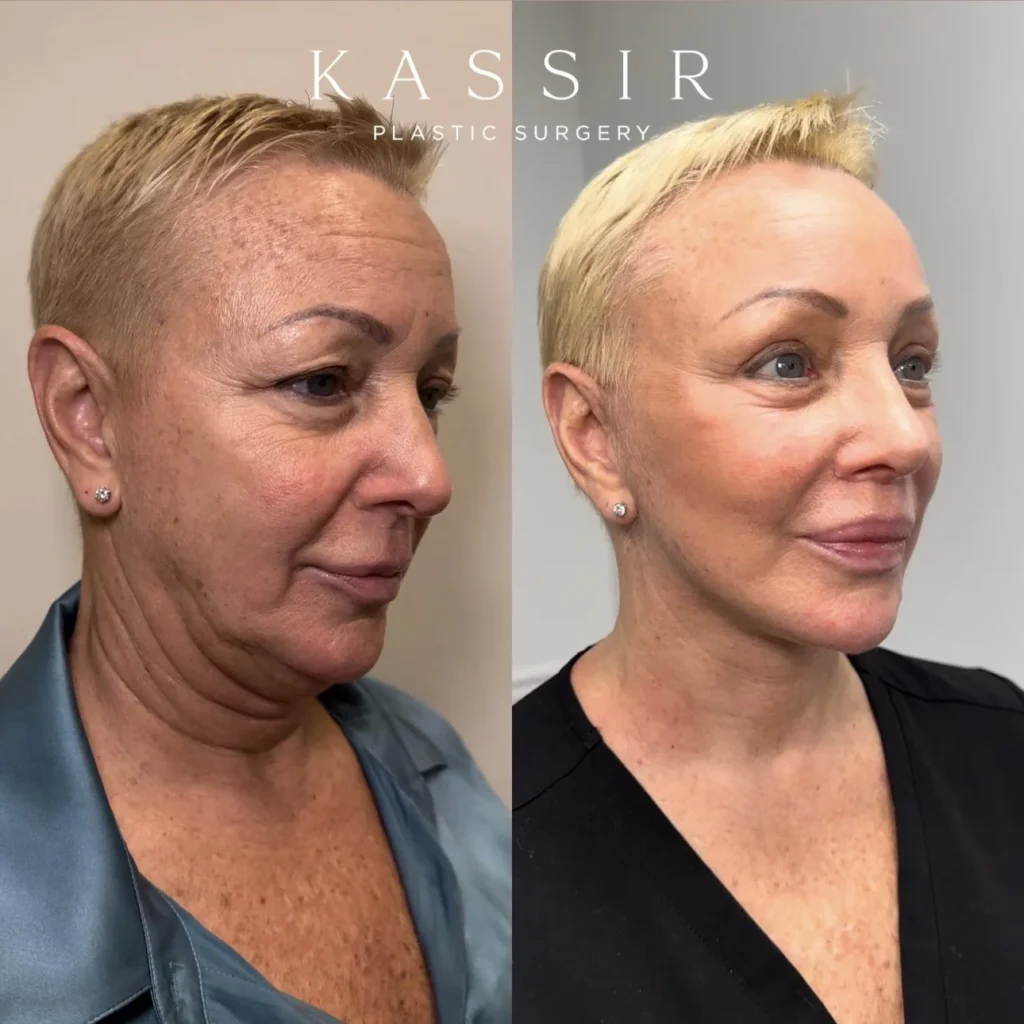 Dr. Kassir - Real patient before and after photo - NYC Facelift