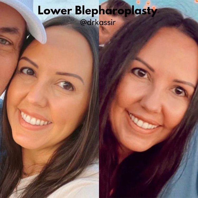BLEPH1-04of04