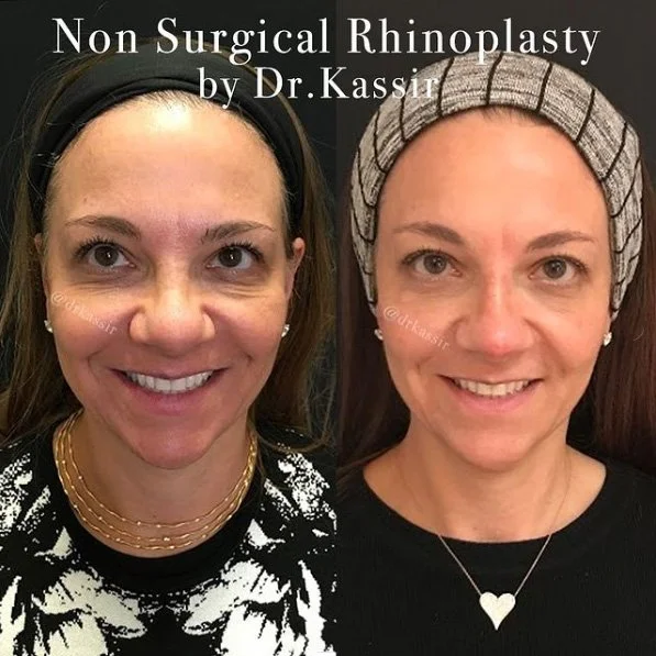 Dr. Kassir - Non Surgical Rhinoplasty real patient before and after photo - front view