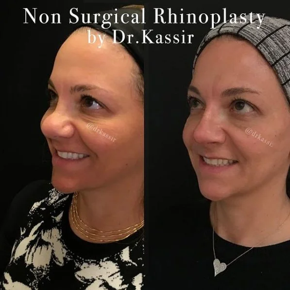Dr. Kassir - Non Surgical Rhinoplasty real patient before and after photo - left angle
