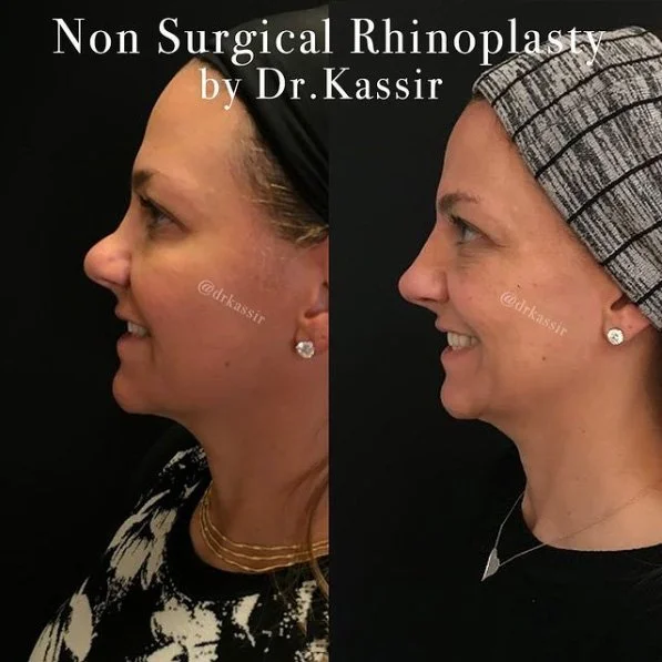 Dr. Kassir - Non Surgical Rhinoplasty real patient before and after photo - left side