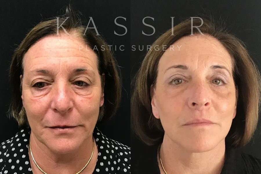Dr. Kassir real patient before and after photos of deep plane facelift
