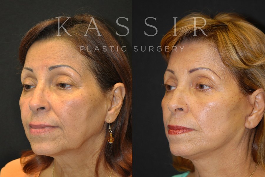 Real patient case after Facelift, NYC and New Jersey, Dr. Kassir