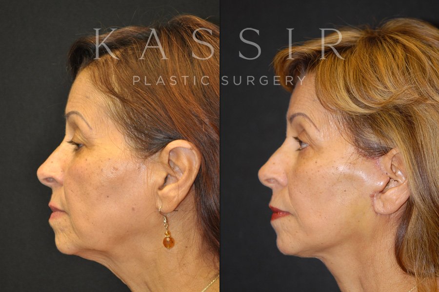Real patient case after Facelift, NYC and New Jersey, Dr. Kassir