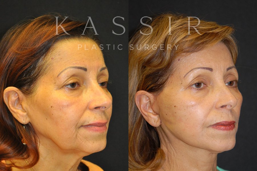 Real patient case after Facelift, NYC and New Jersey, Dr. Kassir