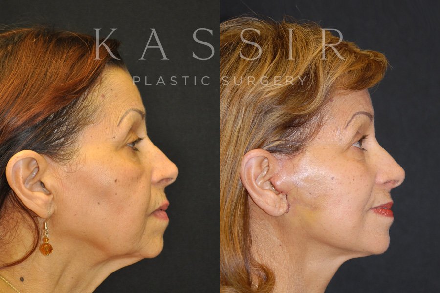Real patient case after Facelift, NYC and New Jersey, Dr. Kassir
