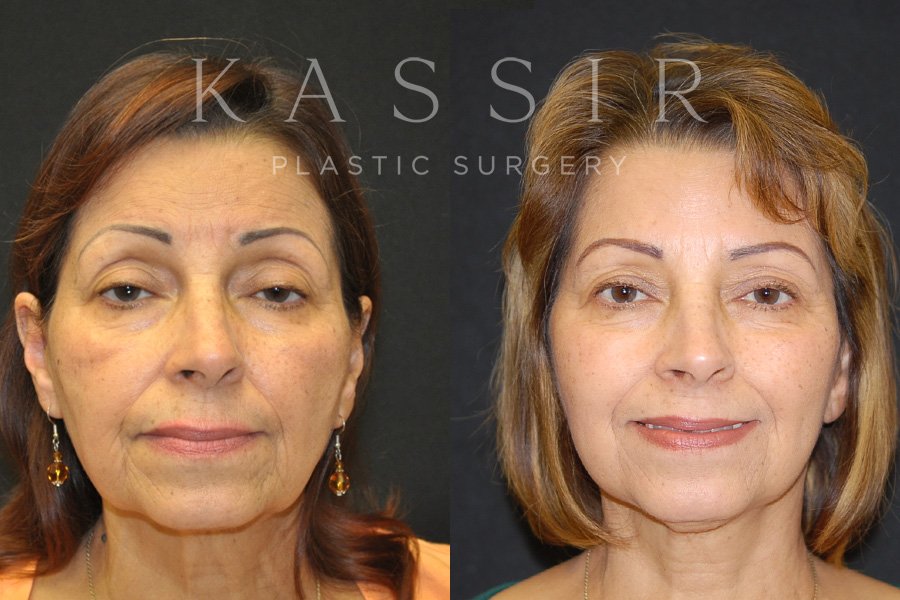 Real patient case after Facelift, NYC and New Jersey, Dr. Kassir