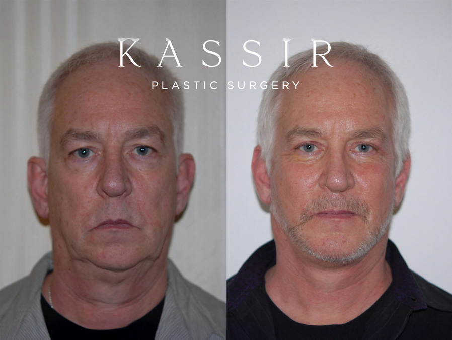 Real patient case Facelift, NYC and New Jersey, Dr. Kassir