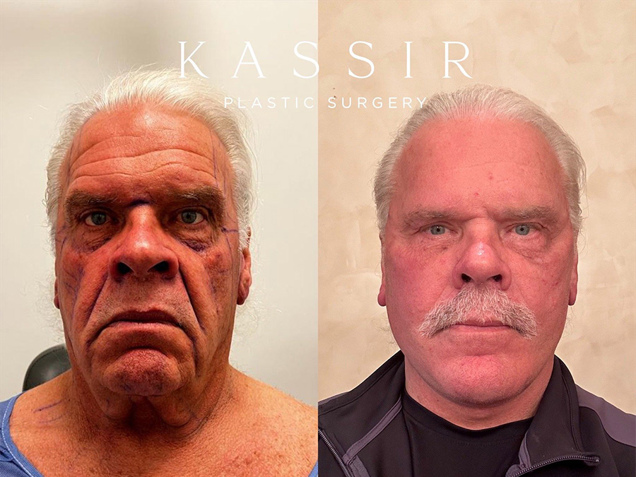 Real patient case Facelift, NYC and New Jersey, Dr. Kassir