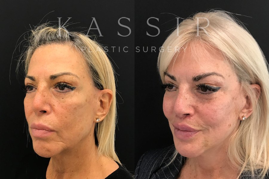 Real patient case after Facelift, NYC and New Jersey, Dr. Kassir