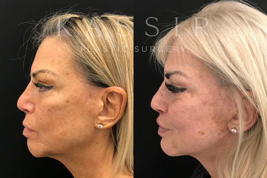 Real patient case after Facelift, NYC and New Jersey, Dr. Kassir