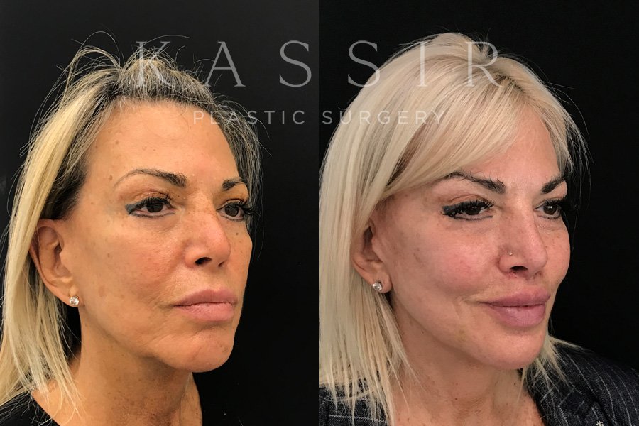 Real patient case after Facelift, NYC and New Jersey, Dr. Kassir