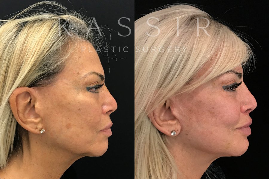 Real patient case after Facelift, NYC and New Jersey, Dr. Kassir
