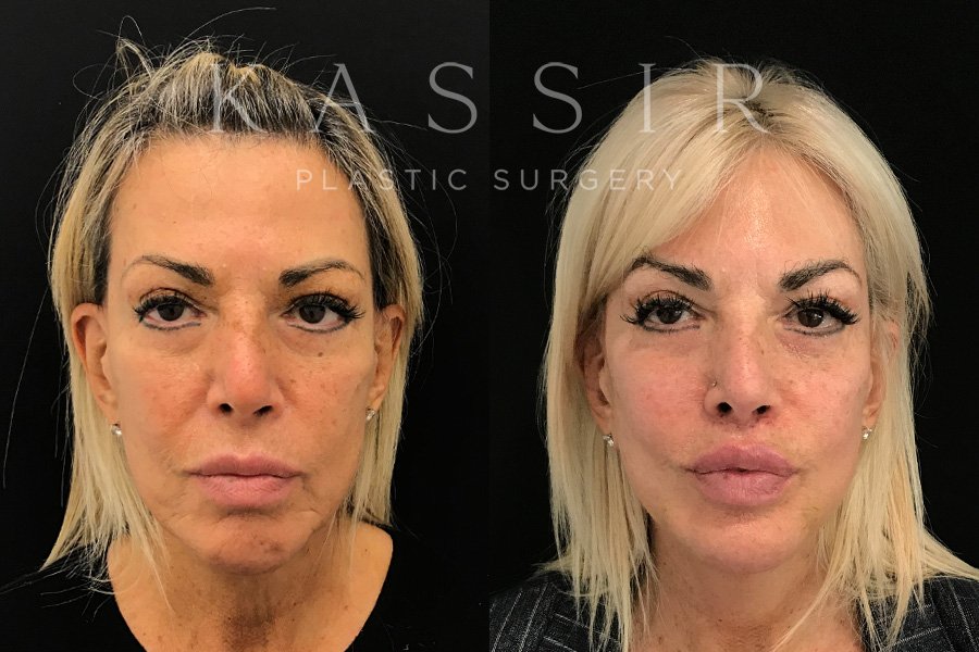 Real patient case after Facelift, NYC and New Jersey, Dr. Kassir