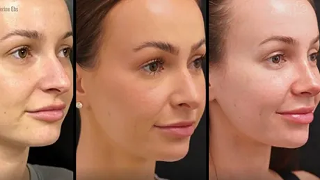 ppl-nose-460×259-1