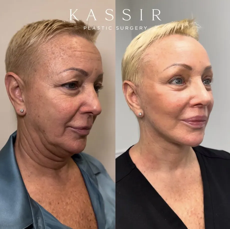Facelift Before & After patient by NYC deep plane facelift surgeon - Dr. Ramtin Kassir