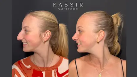 ba-rhinoplasty-media